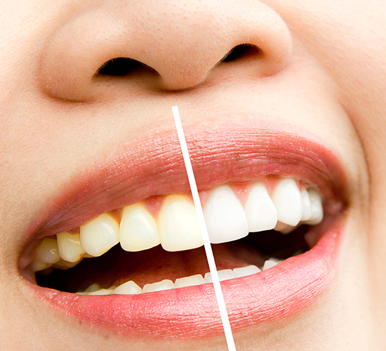 Kayseri Diş Beyazlatma - Bleaching | Dentermis Klinik - Kayseri Ağız ve Diş Sağlığı