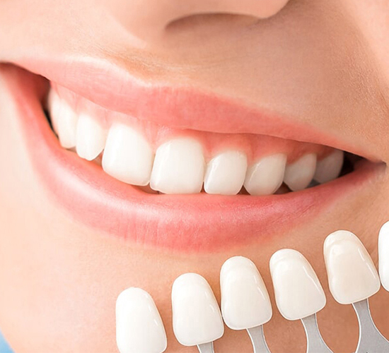 Kayseri Porselen Laminate Diş| Dentermis Ağız ve Diş Sağlığı